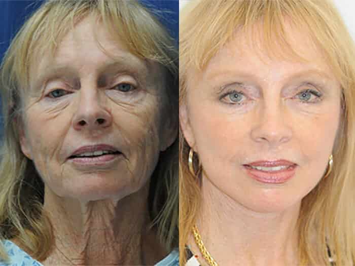 Facelift Before and After Photos 1