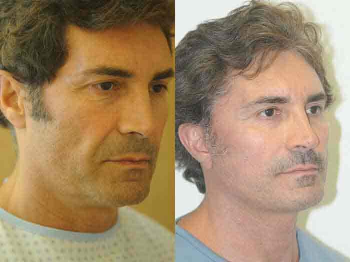 Facelift Plastic Surgeon in Beverly Hills Dr. Renato Calabria