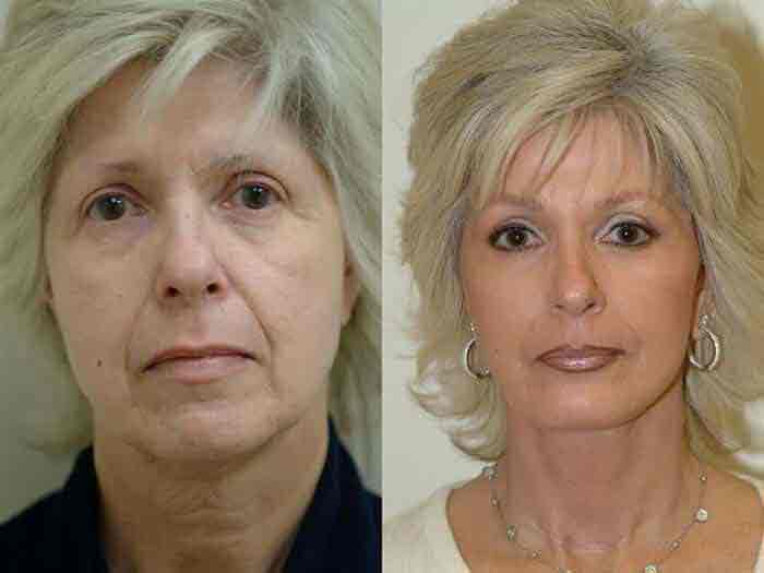 Facelift Before and After Photos 3