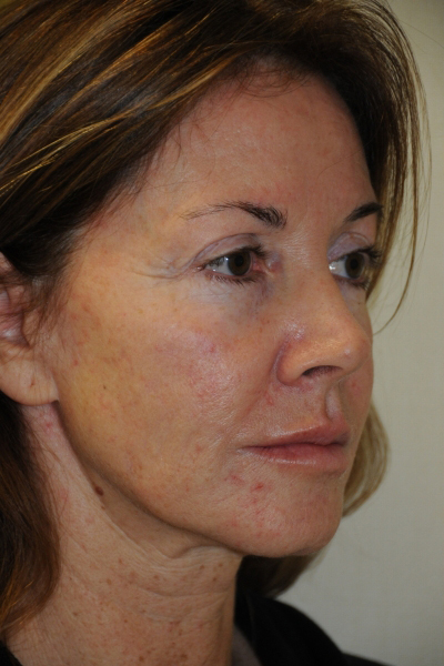 Facelift Patient 06 Before