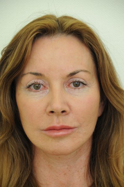 Facelift Patient 06 After - 2