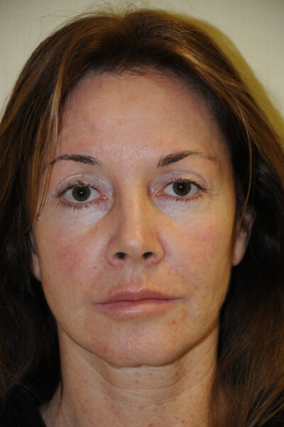 Facelift Patient 06 Before - 2