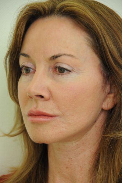 Facelift Patient 06 After - 3