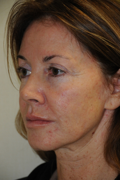 Facelift Patient 06 Before - 3