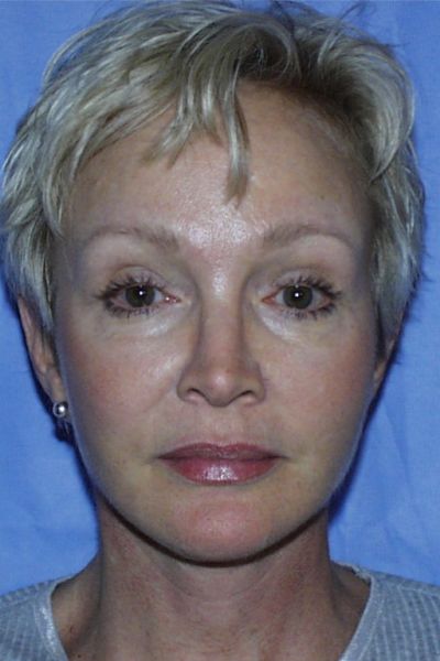 facelift-patient-02 After