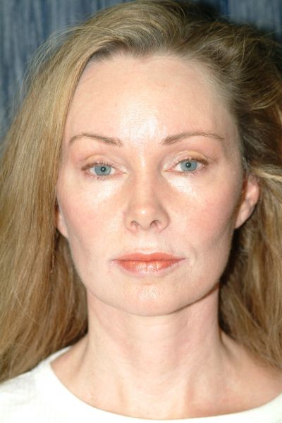 facelift-patient-03 After