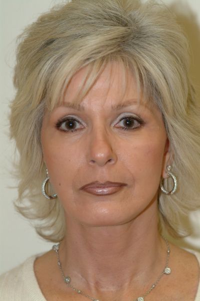 facelift-patient-04 After