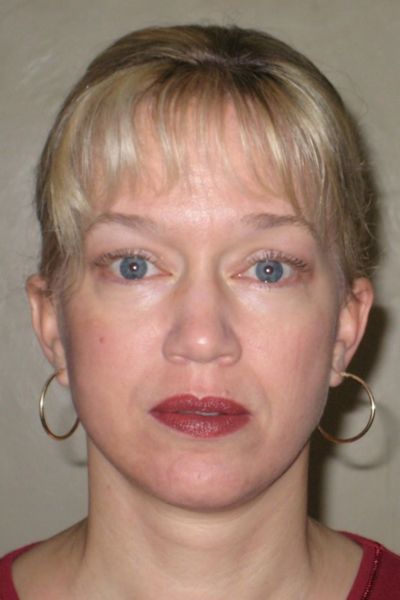 Facelift Patient 05 After - 3