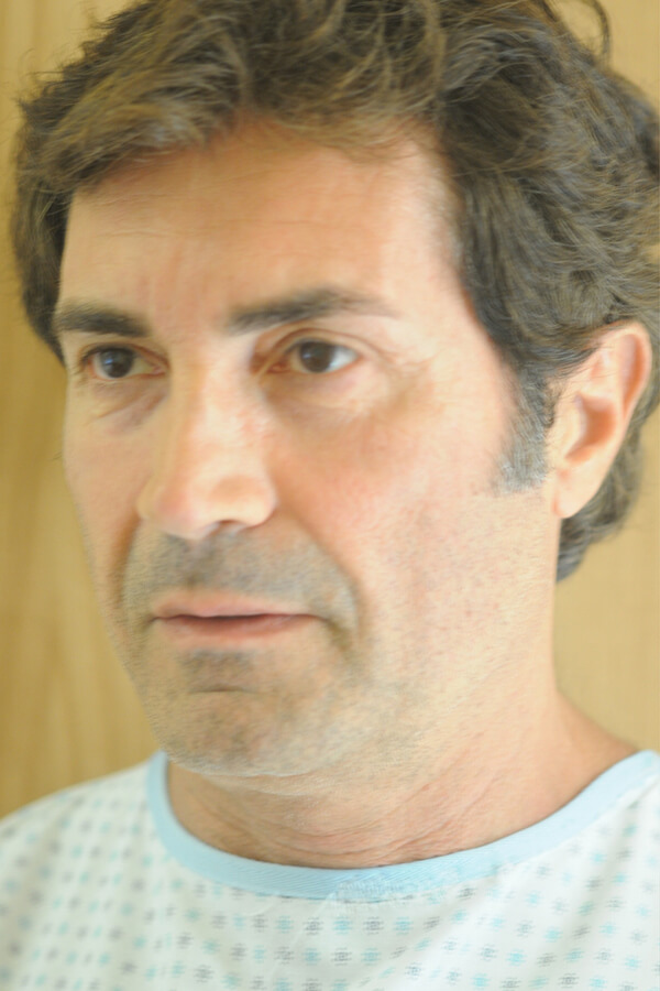 Male Facelift Patient 01 Before