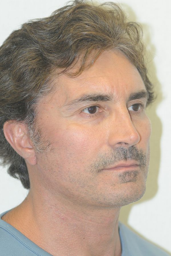 Male Facelift Patient 01 After - 2