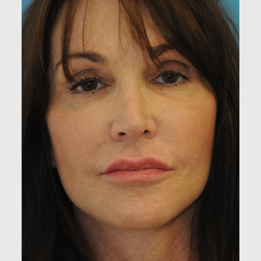 Vertical Facelift Patient 33 After