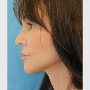 Vertical Facelift Patient 33 After - 4