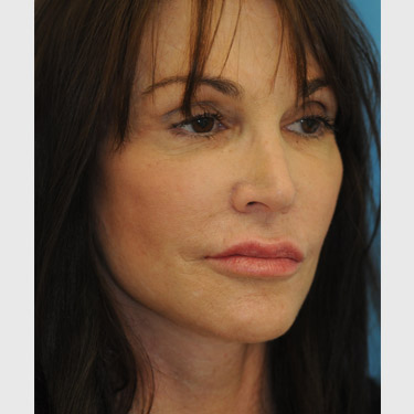 Vertical Facelift Patient 33 After - 3