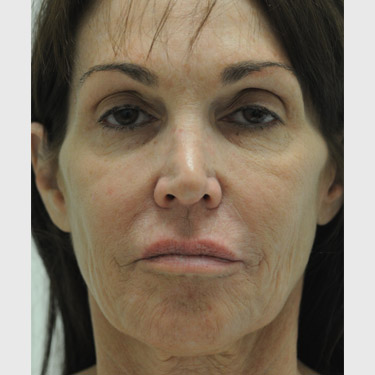 Vertical Facelift Patient 33 Before