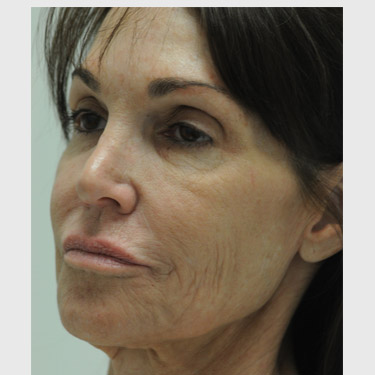 Vertical Facelift Patient 33 Before - 2