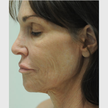 Vertical Facelift Patient 33 Before - 4