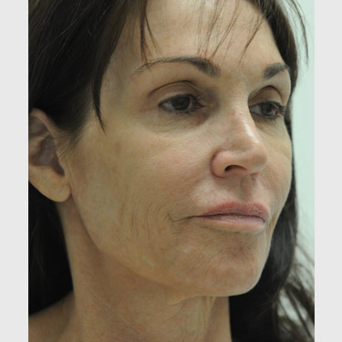 Vertical Facelift Patient 33 Before - 3