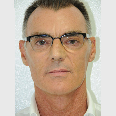 Male Facelift Patient 04 After