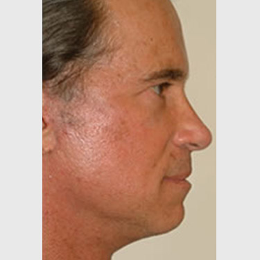 Male Facelift Patient 06 After - 3