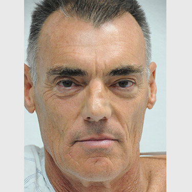 Male Facelift Patient 04 Before