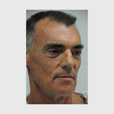 Male Facelift Patient 04 Before - 2