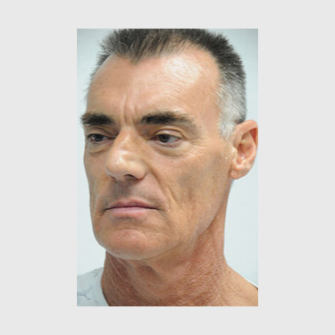 Male Facelift Patient 04 Before - 3