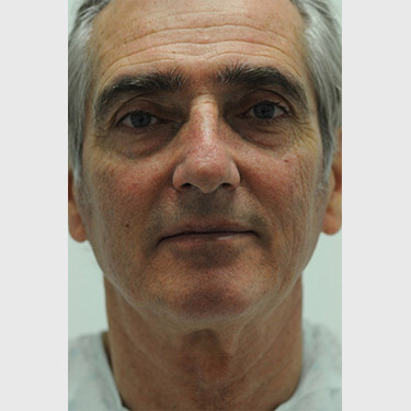 Male Facelift Patient 05 Before