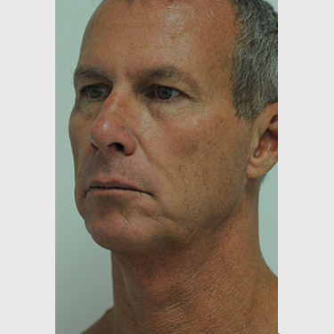Male Facelift Patient 07 Before