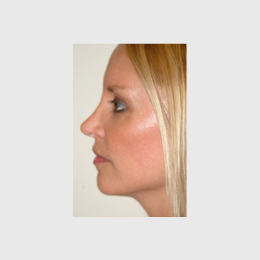 One Stitch Facelift Patient 04 After - 2