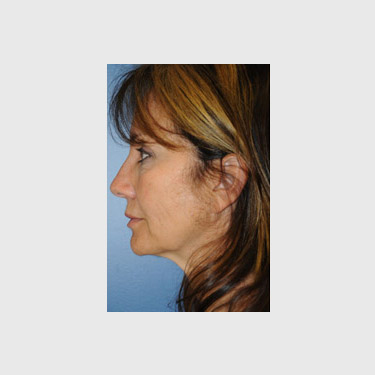 One Stitch Facelift Patient 02 Before - 3