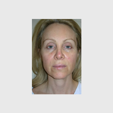 One Stitch Facelift Patient 06 Before