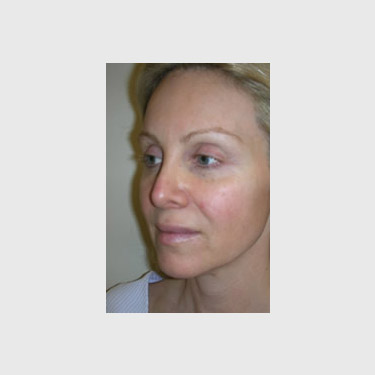 One Stitch Facelift Patient 06 Before - 2