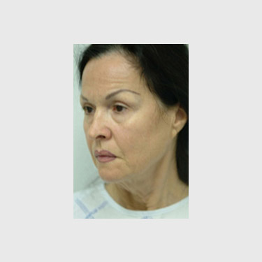 One Stitch Facelift Patient 07 Before - 2