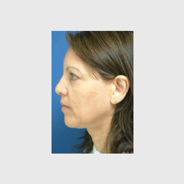 One Stitch Facelift Patient 08 Before - 3