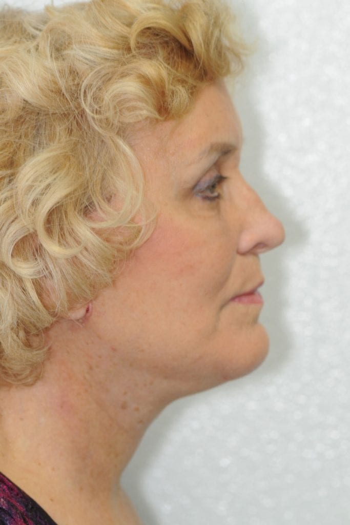 Vertical Facelift Patient 14 After - 4