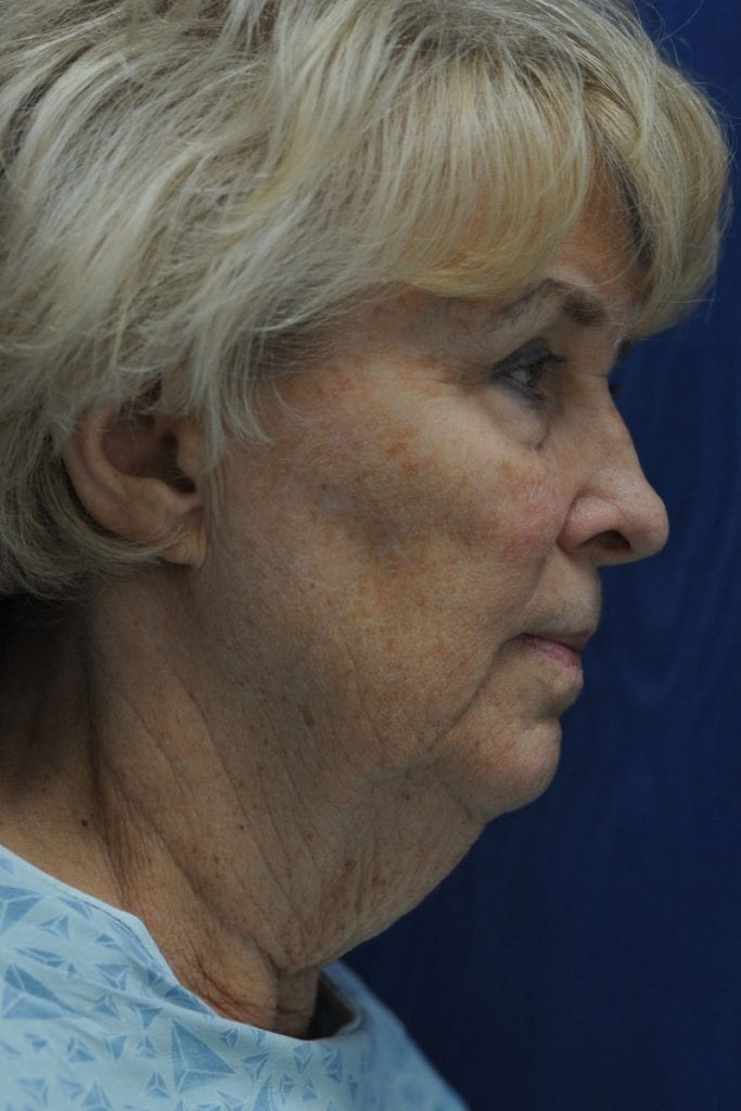 Vertical Facelift Patient 14 Before - 4