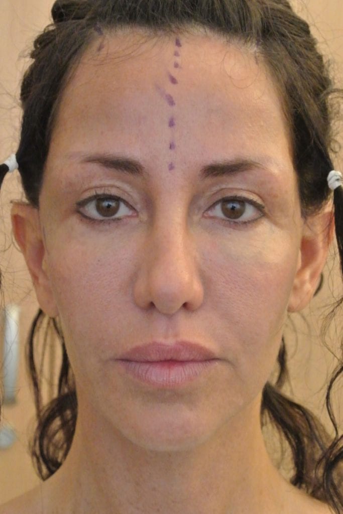 Vertical Facelift Patient 16 Before