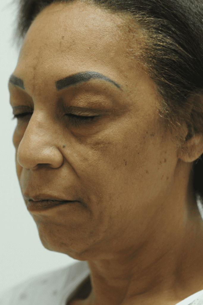 Vertical Facelift Patient 06 Before - 3