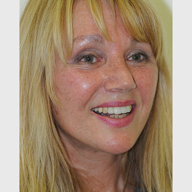 Vertical Facelift Patient 10 After - 2
