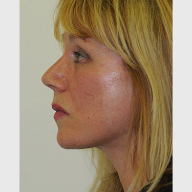 Vertical Facelift Patient 10 After - 3