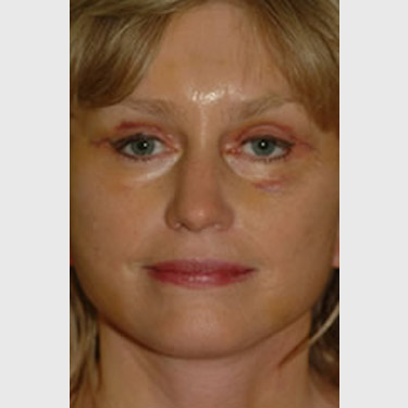 Vertical Facelift Patient 19 After