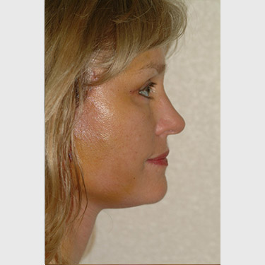 Vertical Facelift Patient 19 After - 2