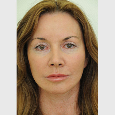 Vertical Facelift Patient 20 After