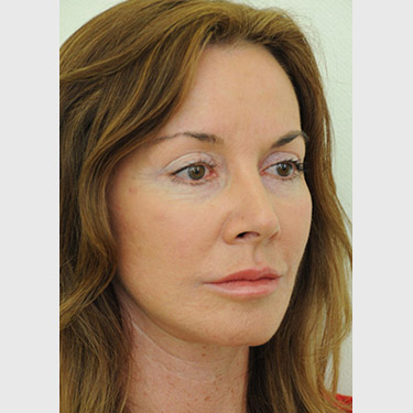 Vertical Facelift Patient 20 After - 2