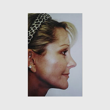 vertical-facelift-patient-22 After