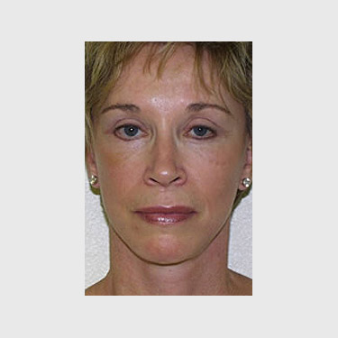 Vertical Facelift Patient 23 After