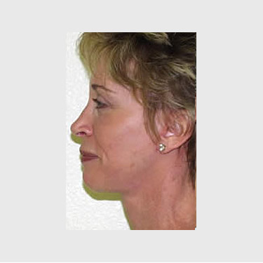 Vertical Facelift Patient 23 After - 3