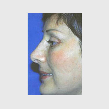 Vertical Facelift Patient 24 After - 2