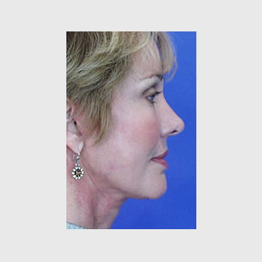 Vertical Facelift Patient 28 After - 3