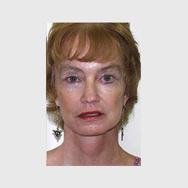 Vertical Facelift Patient 31 After